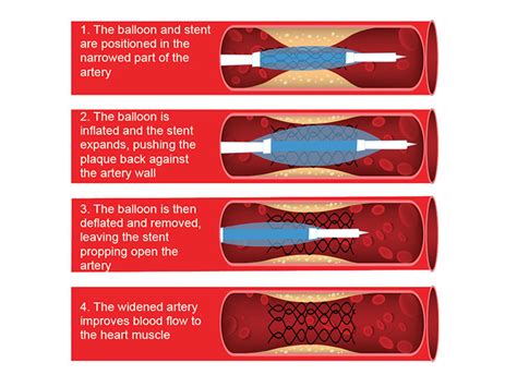 stent pronunciation|how do you spell stents.